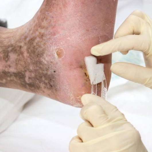 Wound-Care-Experts-phoenix